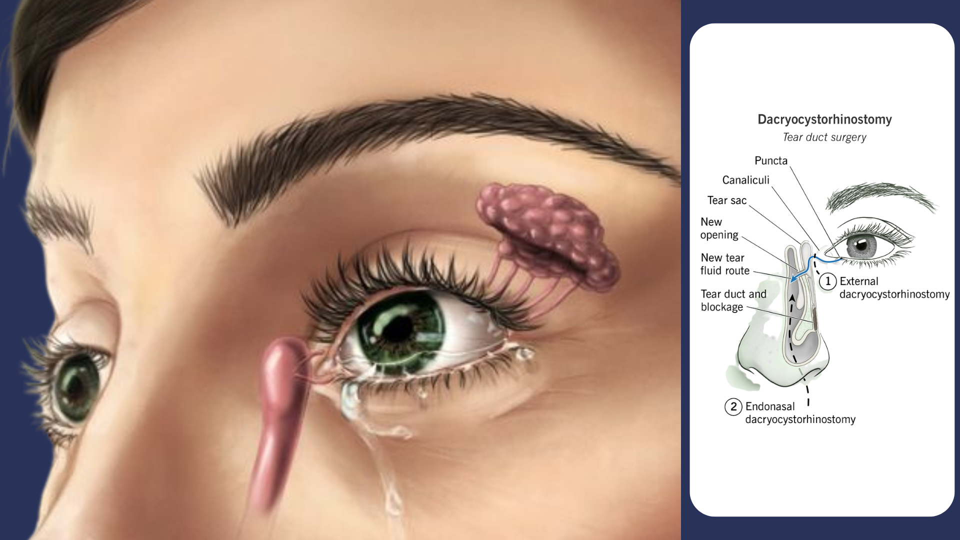Dacryocystorhinostomy (DCR) – Tear Duct Blockage Surgery