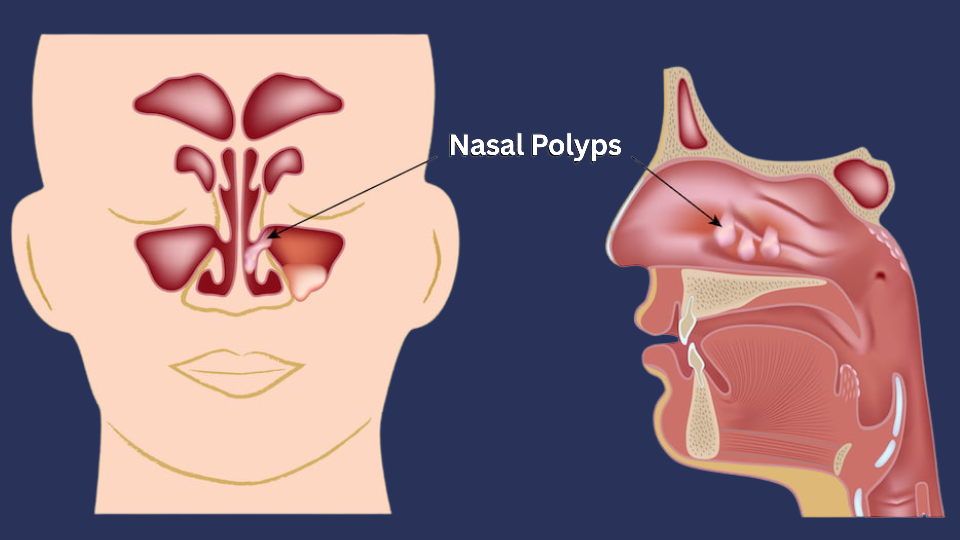 Polypectomy – Nasal Polyp Removal in Rawalpindi