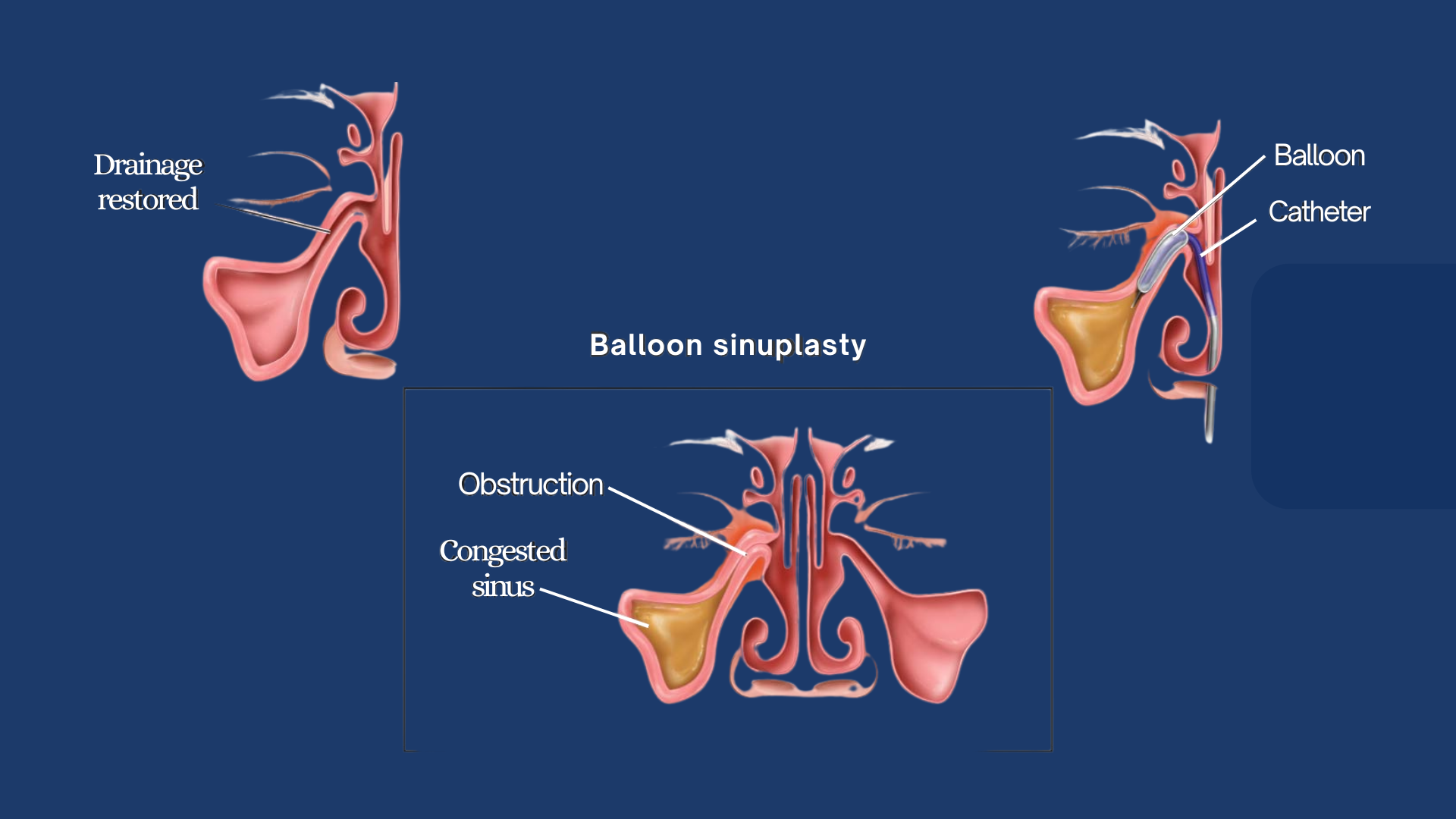 Balloon Sinuplasty – Minimally Invasive Sinus Surgery