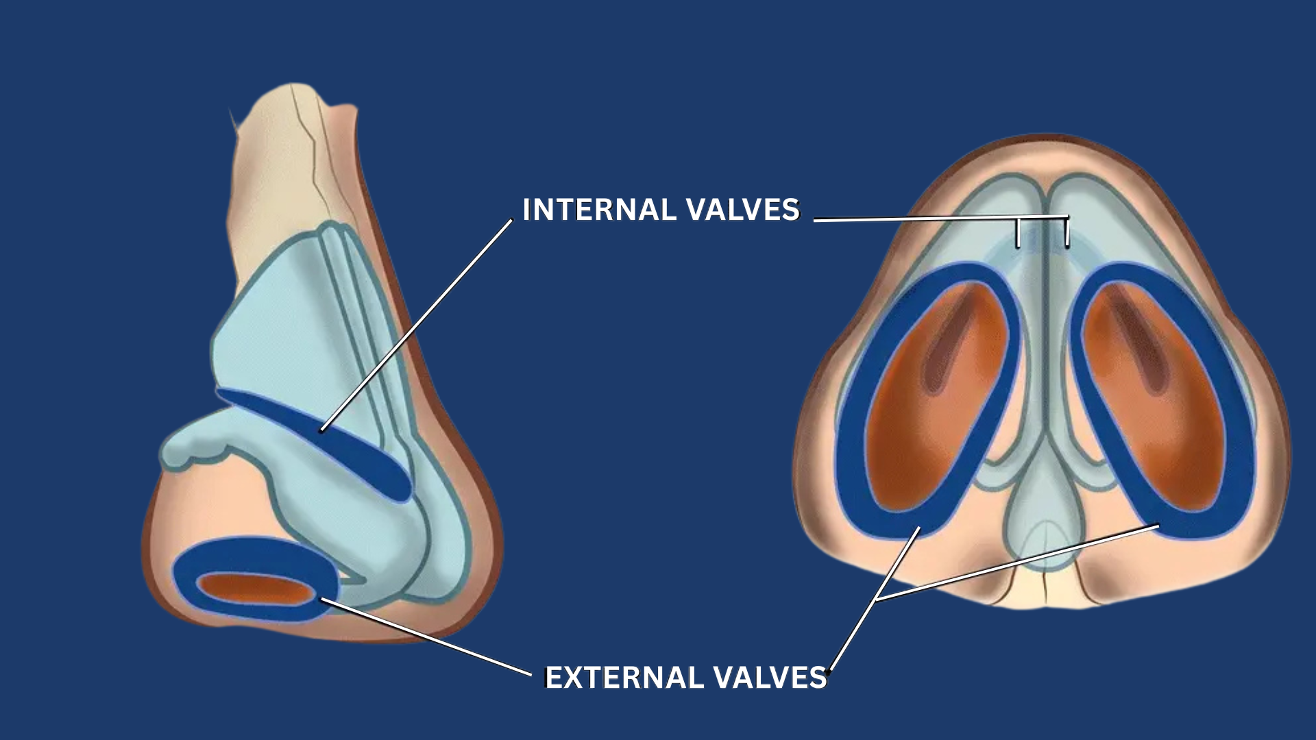 Nasal Valve Reconstruction – Breathing Restoration