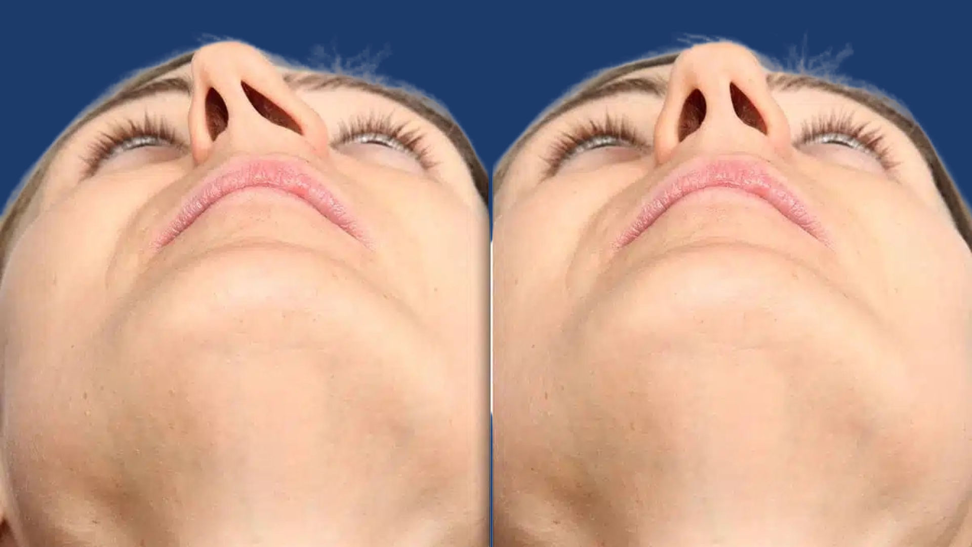 Septoplasty – Deviated Nasal Septum Treatment in Rawalpindi