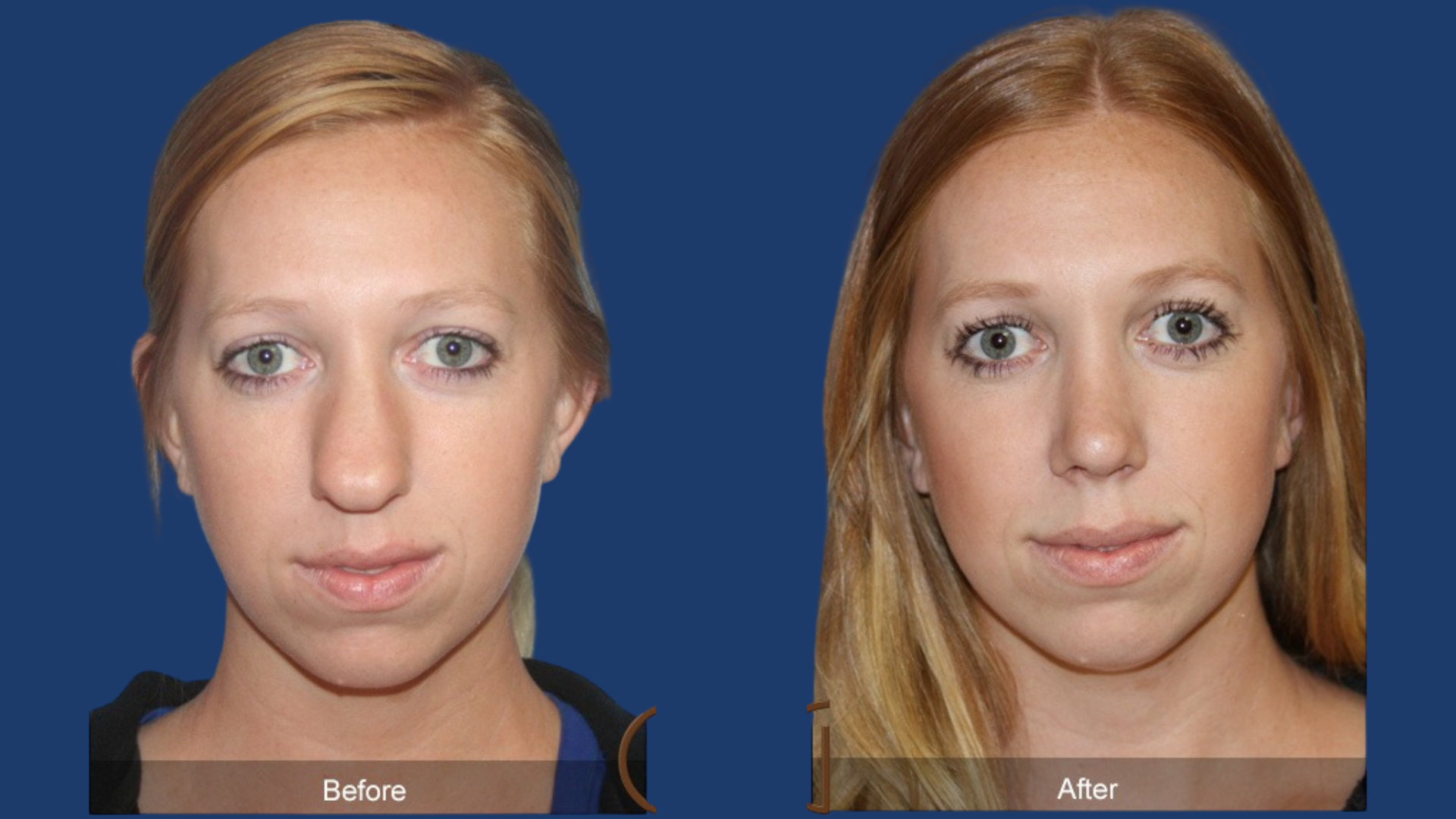 Turbinate Reduction / Cauterization – Nasal Blockage Surgery Rawalpindi