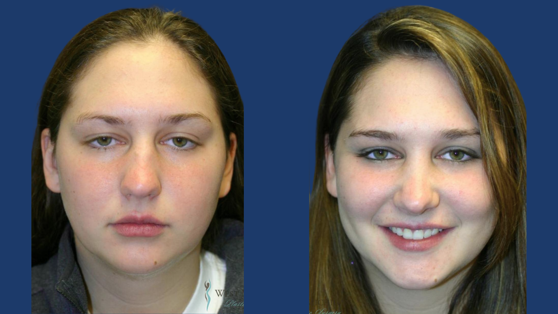 Rhinoplasty – Cosmetic & Functional Nose Surgery Rawalpindi